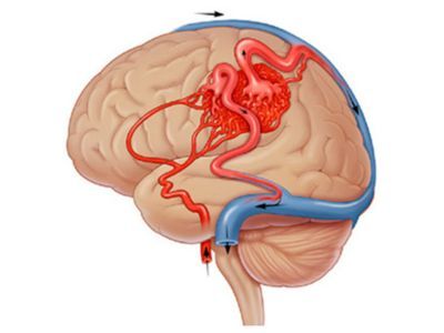 Brain & Spine Vascular Disease