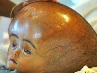 Hydrocephalus (Paediatric)